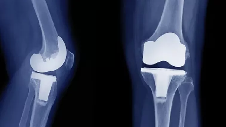 Scan of knees after knee replacement surgery